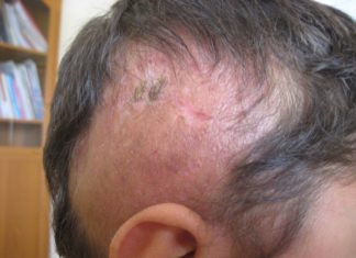 Experimental drug reverses hair loss and skin damage linked to fatty diet