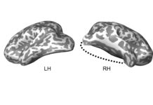 A new study led by Carnegie Mellon University neuroscientists provides the first evidence of how the human brain recovers the ability to function after losing parts of the visual system