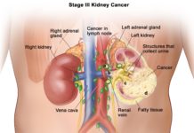 Scientists have uncovered a potential therapeutic target for kidney cancers that have a common genetic change