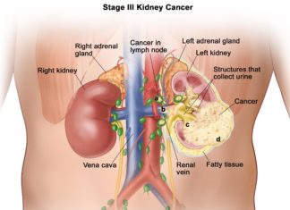 Scientists have uncovered a potential therapeutic target for kidney cancers that have a common genetic change