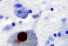 Researchers trace Parkinson’s damage in the heart