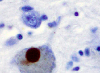 Researchers trace Parkinson’s damage in the heart