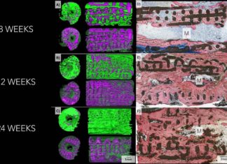 3D-printed implants chemically coated, ceramic implants successfully guided the regrowth of missing bone