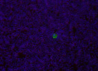 University of Copenhagen have discovered a method of diagnosing a broad range of cancers at their early stages by utilising a particular malaria protein