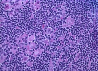 A blood test can predict which patients with a type of cancer called diffuse large B cell lymphoma are likely to respond positively to initial therapy and which are likely to need more aggressive treatment