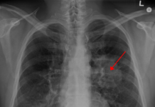 A team of Institute researchers have discovered how to stop and reverse the growth of lung cancer with a potent combination of three molecules