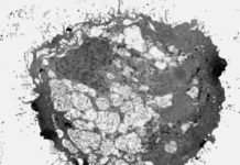 Aggressive brain tumour cells taken from patients self-destructed after being exposed to a chemical in laboratory tests