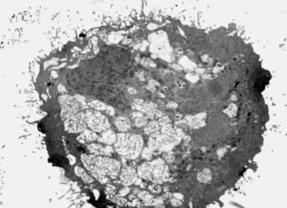 Aggressive brain tumour cells taken from patients self-destructed after being exposed to a chemical in laboratory tests