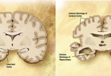 Alzheimer’s disease is difficult to diagnose as well as treat, but researchers now have a promising new screening tool using the window to the brain: the eye