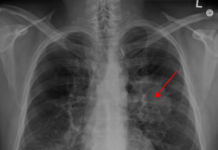 Chemotherapy may cause acute amenorrhea leading to early menopause in women with lung cancer