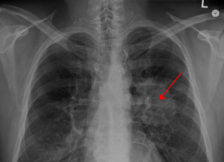 Chemotherapy may cause acute amenorrhea leading to early menopause in women with lung cancer