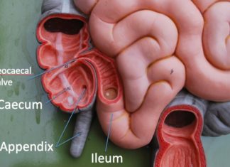 Children with allergies have a lower risk of developing complicated appendicitis