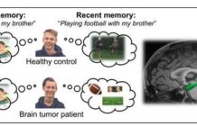 Children with certain types of brain tumors who undergo radiation treatment are less likely to recall the specifics of events they experienced after radiation than to remember pre-treatment happenings