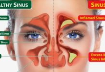 Chronic allergic inflammation in the sinus – conseguence of Cellular changes