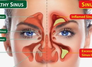 Chronic allergic inflammation in the sinus – conseguence of Cellular changes