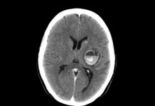 Combination immunotherapy shrank melanoma that has spread to the brain in more than half of the patients in a clinical trial
