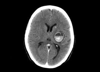 Combination immunotherapy shrank melanoma that has spread to the brain in more than half of the patients in a clinical trial