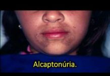 Find drug that treats the extremely rare genetic disease alkaptonuria (AKU)