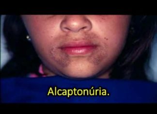Find drug that treats the extremely rare genetic disease alkaptonuria (AKU)