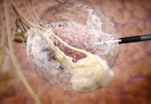 IceCure Medical : tumor freezing technology to fight benign breast tumors and cancerous kidney tumors without the need for surgery