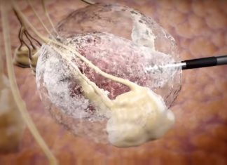 IceCure Medical : tumor freezing technology to fight benign breast tumors and cancerous kidney tumors without the need for surgery