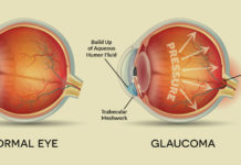 Immune cells in the eye that developed in response to early exposure to bacteria are a key contributor to progressive vis8/9/2018ion loss from glaucoma