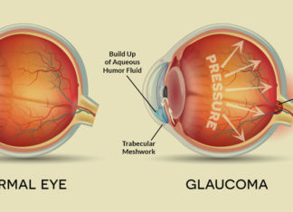Immune cells in the eye that developed in response to early exposure to bacteria are a key contributor to progressive vis8/9/2018ion loss from glaucoma