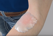 Israeli researcher say they have managed to cure fungal infections using bacteria commonly found in the upper layers of soil