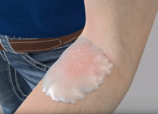 Israeli researcher say they have managed to cure fungal infections using bacteria commonly found in the upper layers of soil