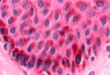 Keratinocyte skin cells are common targets of the beta subtype of human papilloma virus