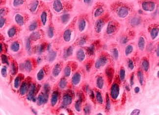 Keratinocyte skin cells are common targets of the beta subtype of human papilloma virus