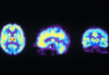 Ketamine works as an antidepressant at least in part by activating the brain’s opioid system