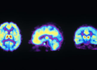 Ketamine works as an antidepressant at least in part by activating the brain’s opioid system