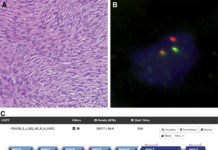 New assay to detect genetic abnormalities in sarcomas