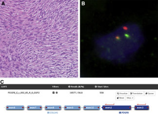 New assay to detect genetic abnormalities in sarcomas