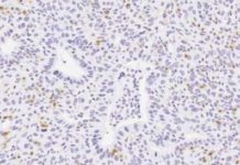 Scientists revealed that a molecule called interleukin-35 plays a role in suppressing cancer-fighting immune cells in pancreatic cancer