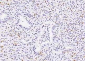 Scientists revealed that a molecule called interleukin-35 plays a role in suppressing cancer-fighting immune cells in pancreatic cancer