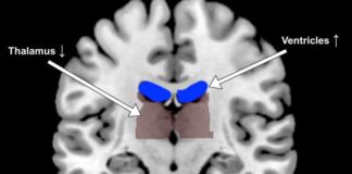 Dehydration alters human brain shape and activity, slackens task performance