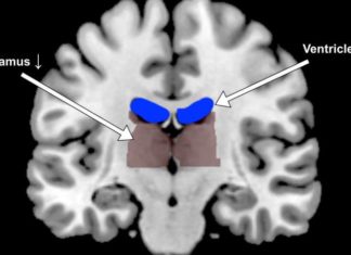 Dehydration alters human brain shape and activity, slackens task performance