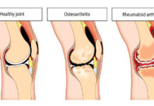 A study examining how molecules are transported into knee-joint tissue could have major implications for understanding and treating arthritis