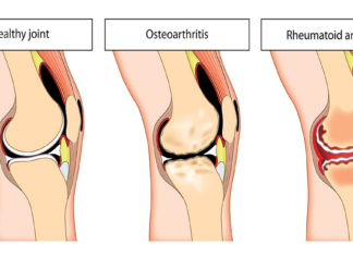 A study examining how molecules are transported into knee-joint tissue could have major implications for understanding and treating arthritis