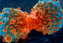 Scientists have discovered that some childhood bone cancers start growing years before they are currently diagnosed