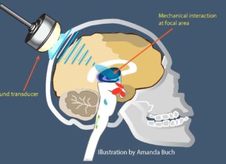 Focused ultrasound can be used to safely open the blood-brain barrier (BBB) in patients with Alzheimer’s disease