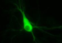 HIV-associated neurocognitive disorders can range from mild disorders that cause no symptoms to severe dementia
