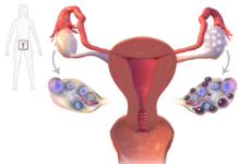 Women with polycystic ovary syndrome (PCOS) are more likely than other women to have an autistic child
