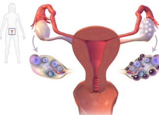 Women with polycystic ovary syndrome (PCOS) are more likely than other women to have an autistic child