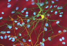 The inherited gene that leads to Huntington’s disease has been found to affect brain development from an early age