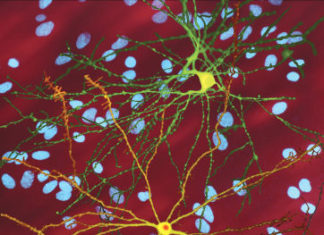 The inherited gene that leads to Huntington’s disease has been found to affect brain development from an early age