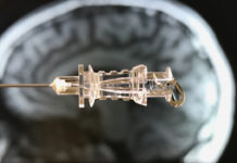 A simple blood test can detect the earliest changes caused by Huntington’s disease