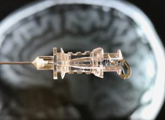 A simple blood test can detect the earliest changes caused by Huntington’s disease